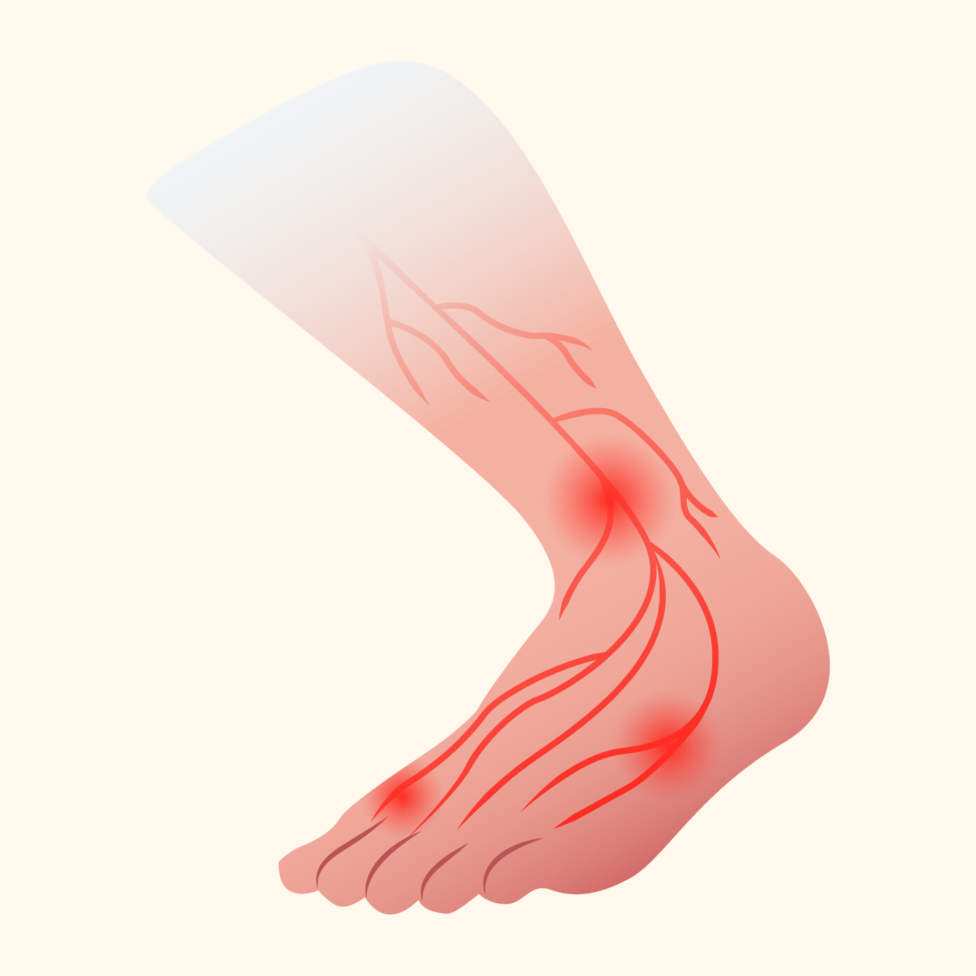 Neuropathy