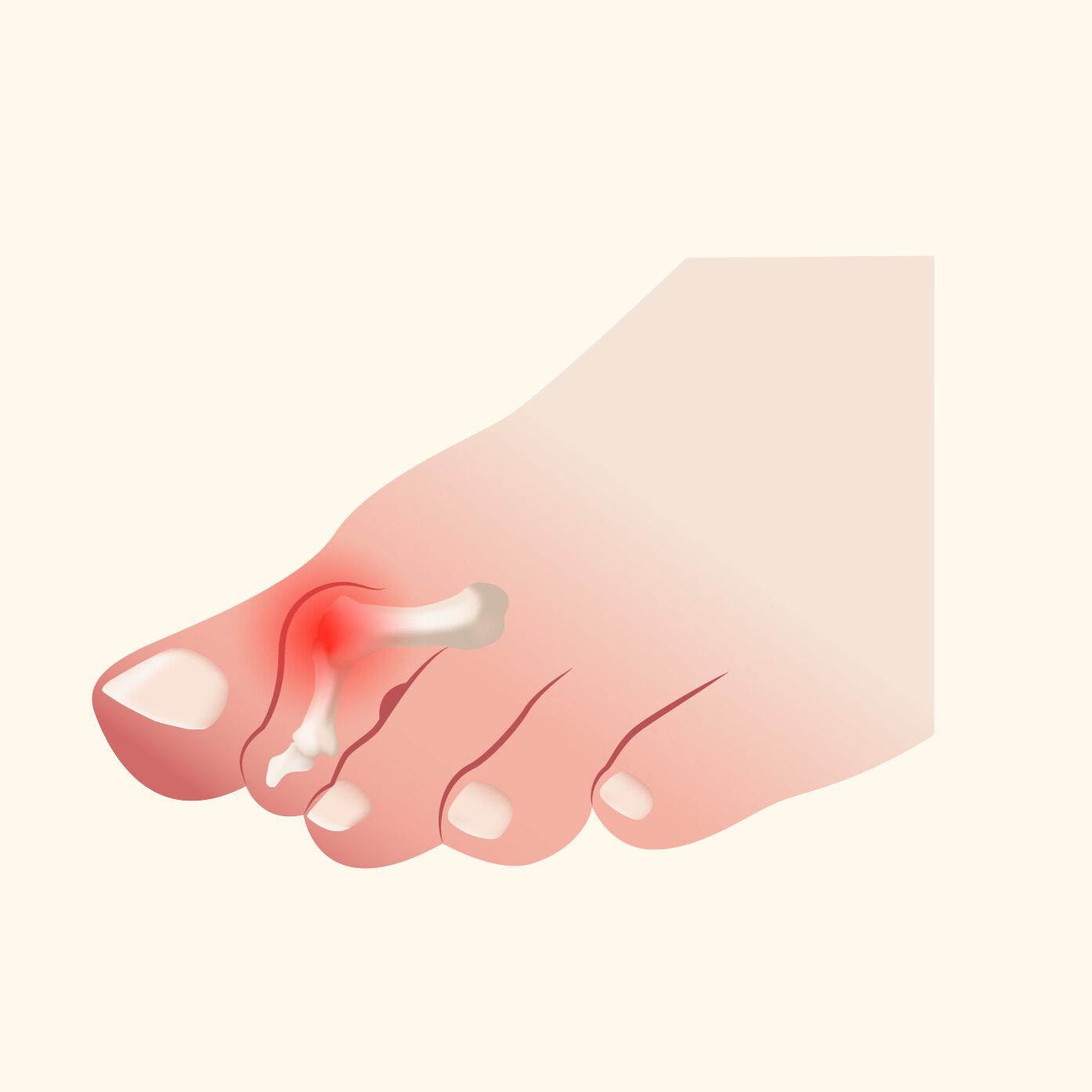 Hammer Toe