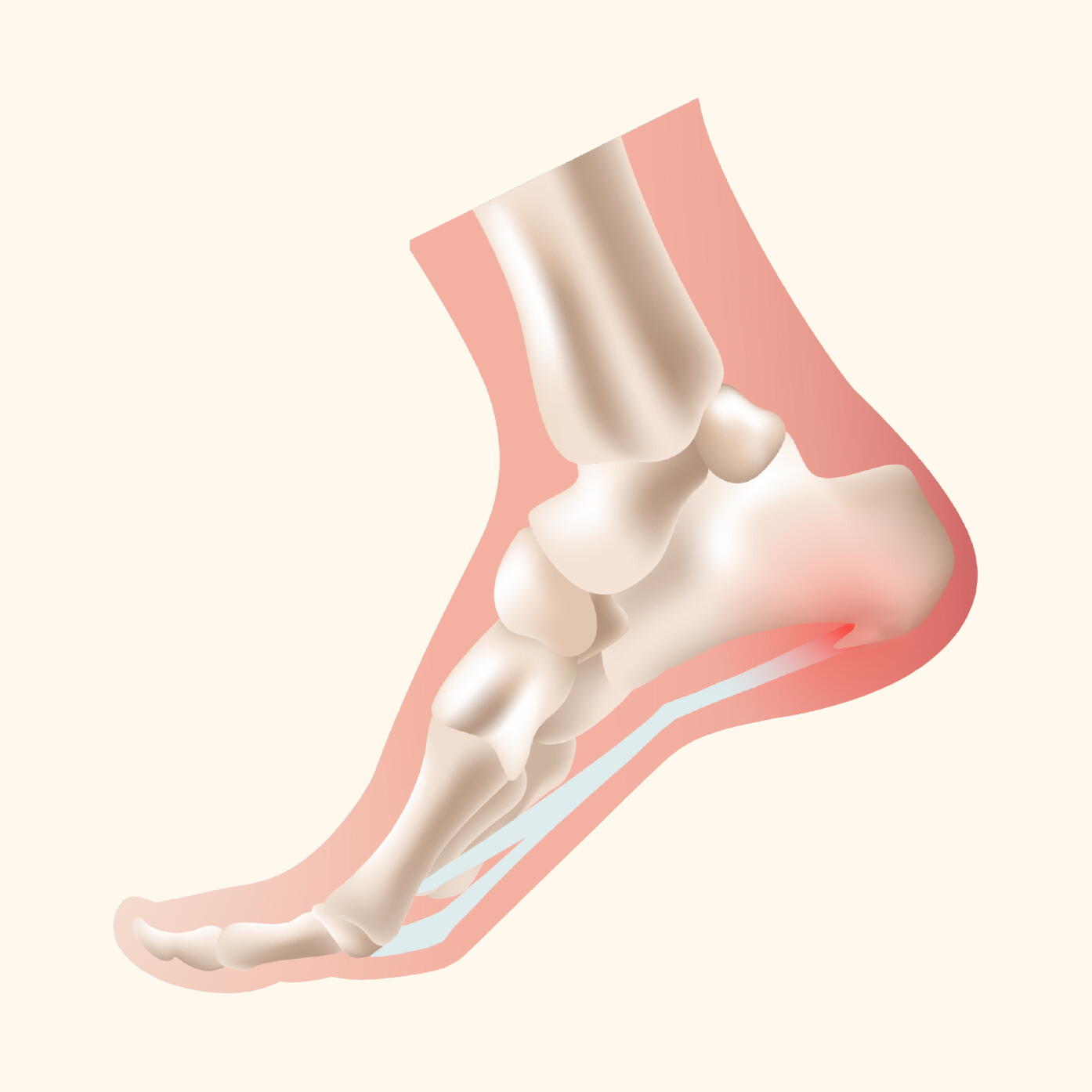 Heel Spurs