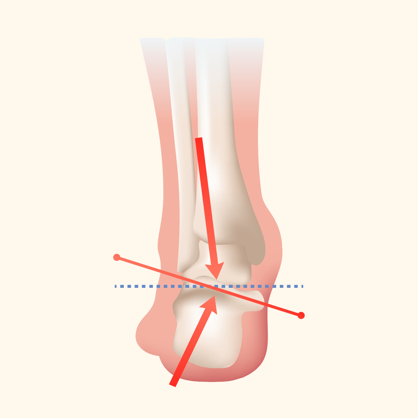 Over Pronation